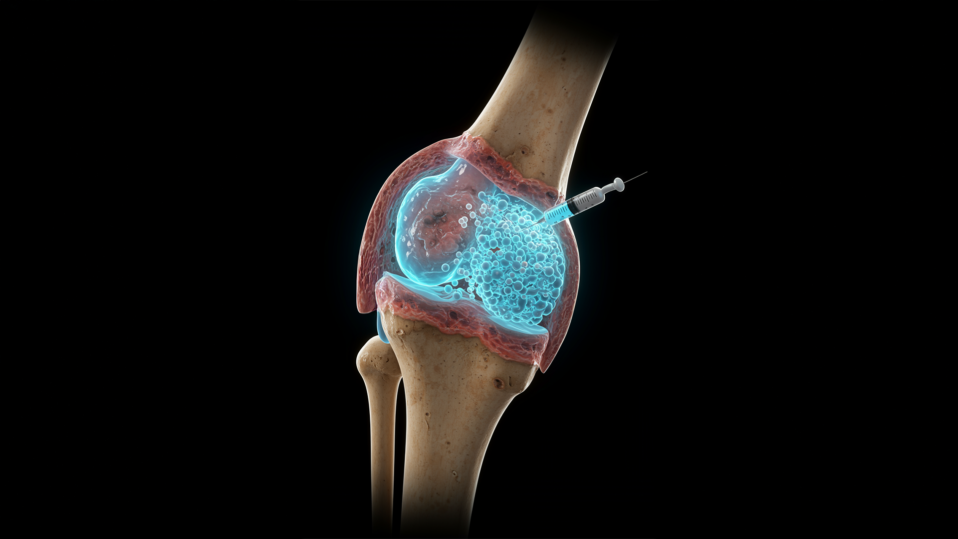 Eklem Sağlığında Devrim: Osteoartrit Artık Geri Dönüştürülebilir mi?