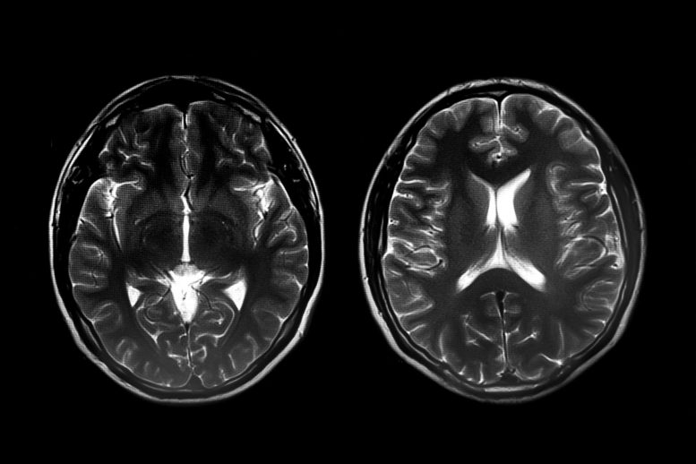 two-brain-scans-777x518